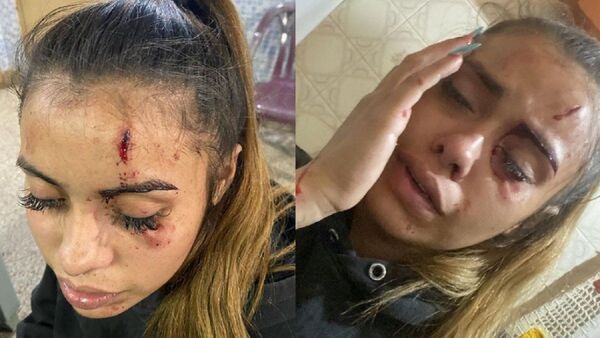 Bailarina denunció que su hermano la golpeó brutalmente