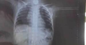La Nación / Instan a atención minuciosa de los padres para evitar aspiración de cuerpos extraños en niños pequeños