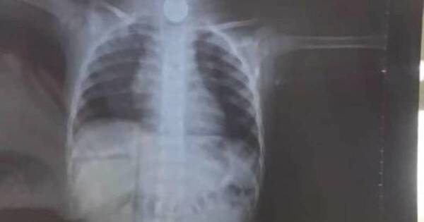 La Nación / Instan a atención minuciosa de los padres para evitar aspiración de cuerpos extraños en niños pequeños