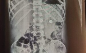 Susto con suerte: Niño se salvó tras haber tragado una pila