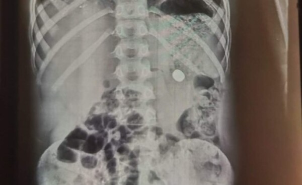 Susto con suerte: Niño se salvó tras haber tragado una pila