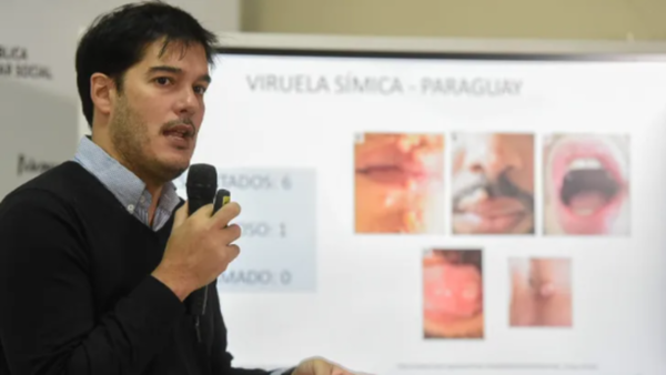 Viruela del mono: confirman circulación comunitaria