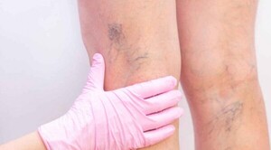 Instan a cuidarse a mujeres con antecedentes familiares de venas varicosas