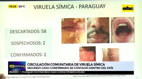Viruela de mono ya es comunitaria - ABC Noticias - ABC Color