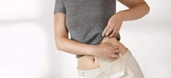 Ostomía: una solución a varios problemas de salud - Estilo de vida - ABC Color