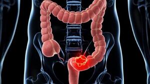 Identifican un nuevo gen clave para el crecimiento del cáncer de colon