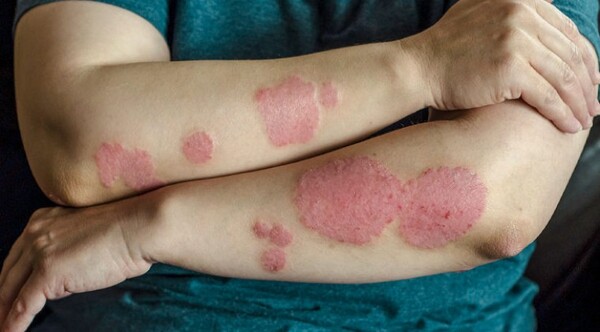 Diario HOY | Psoriasis, una enfermedad que afecta más allá de la piel