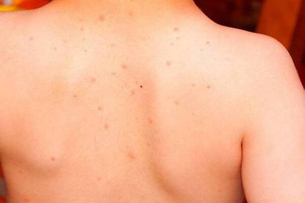 Crónica / Hernandarias: Se detectó varicela en 15 estudiantes de una escuela