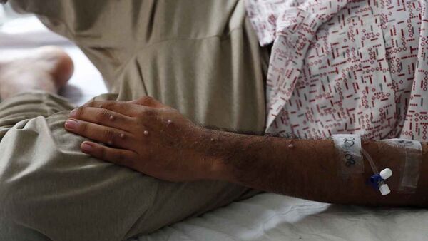 Salud confirma tercer caso de viruela del mono en Paraguay