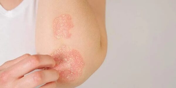 Recuerdan el “Día Mundial de la Psoriasis” - Estilo de vida - ABC Color