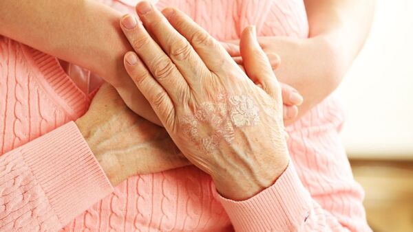 Especialistas buscan concientizar a la población sobre la psoriasis