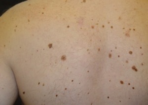 Atención dermatológica para concienciar sobre cuidados contra rayos UV | 1000 Noticias