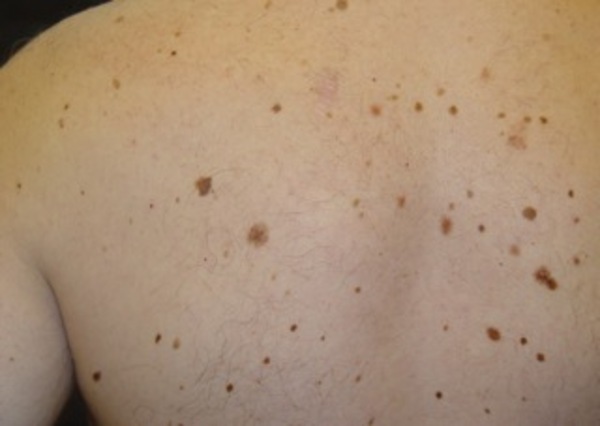 Atención dermatológica para concienciar sobre cuidados contra rayos UV | 1000 Noticias