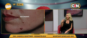 Lunares: ¿Cuándo consultar al dermatólogo? - C9N