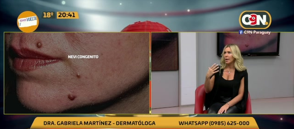 Lunares: ¿Cuándo consultar al dermatólogo? - C9N