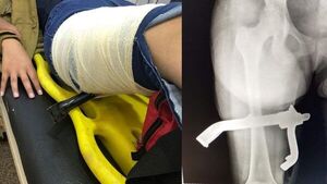 Patita de la moto atravesó pierna de una joven