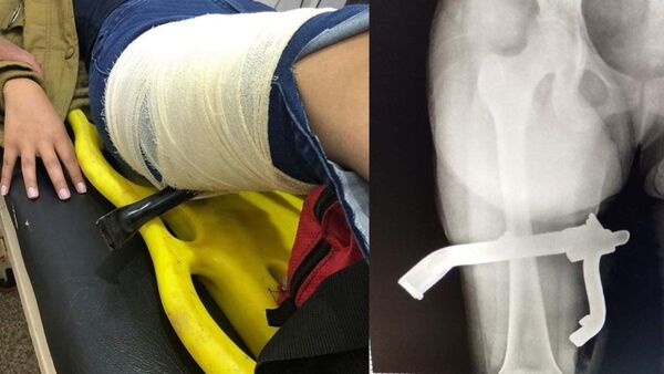 Patita de la moto atravesó pierna de una joven