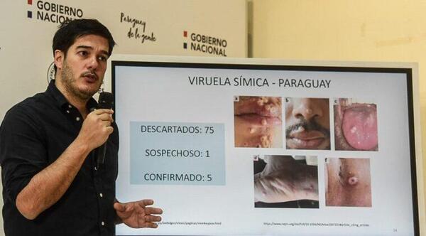 El titular de Vigilancia de la Salud, alerta sobre una virus símica que está en circulación – Prensa 5