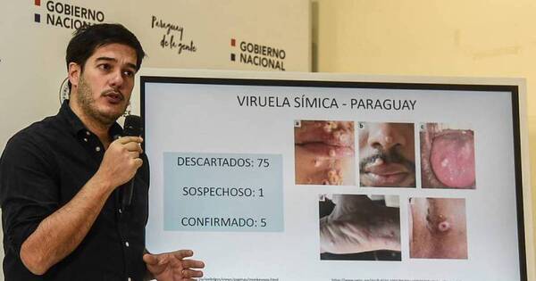 La Nación / Viruela símica: Ratifican circulación comunitaria