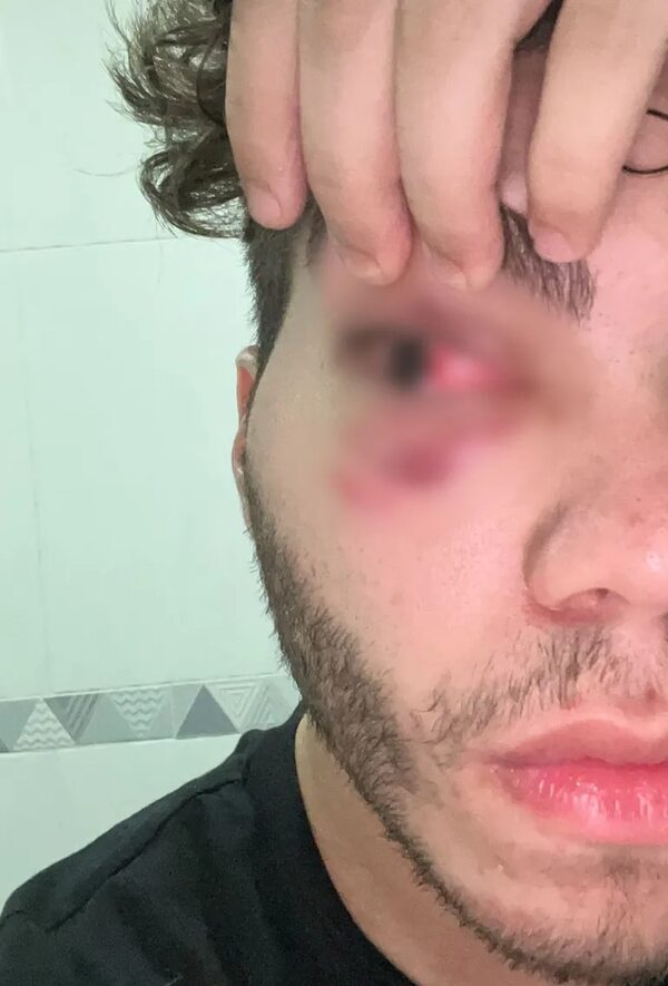 Otro joven casi pierde el ojo en Morgan, mismo local donde atacaron al hijo de Raúl Zapag - Nacionales - ABC Color