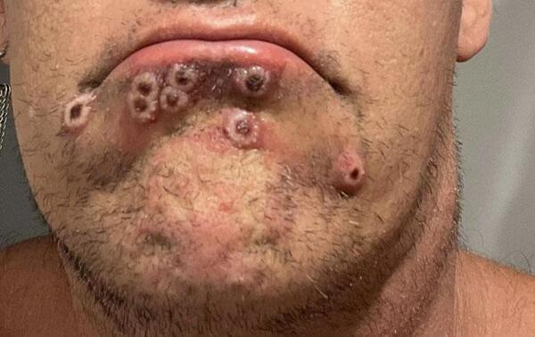 Confirman dos casos de viruela del mono y cifra total sube a siete – Prensa 5