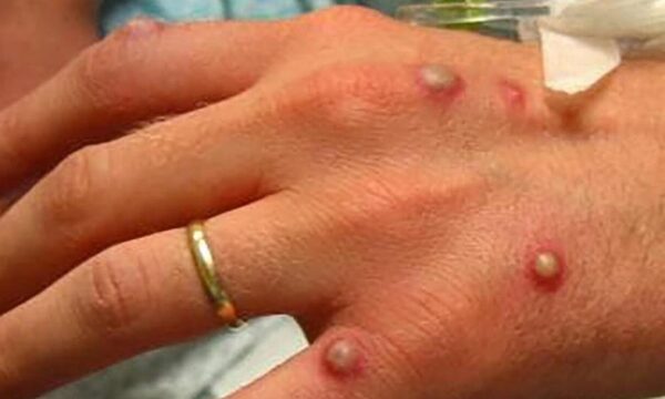 Suman los casos de viruela símica en el país