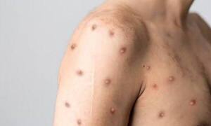 Salud reporta que suman los casos de viruela mono - trece