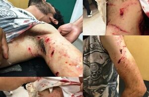 Jagua Pitbull atacó a un albañil y lo dejó con el brazo destrozado