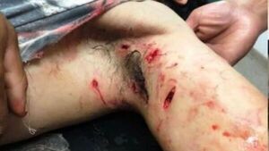 Pitbull destrozó el brazo a un albañil