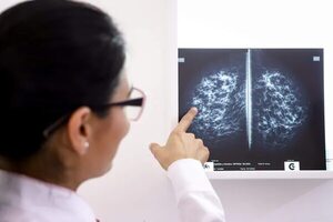 Identifican un posible biomarcador de detección precoz de cáncer de mama - Ciencia - ABC Color