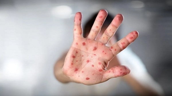 Casos de viruela del mono se duplican en el país - Paraguaype.com