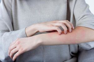 Diario HOY | Dermatitis atópica: nuevos paradigmas en el tratamiento para pacientes