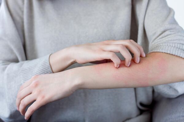 Diario HOY | Dermatitis atópica: nuevos paradigmas en el tratamiento para pacientes