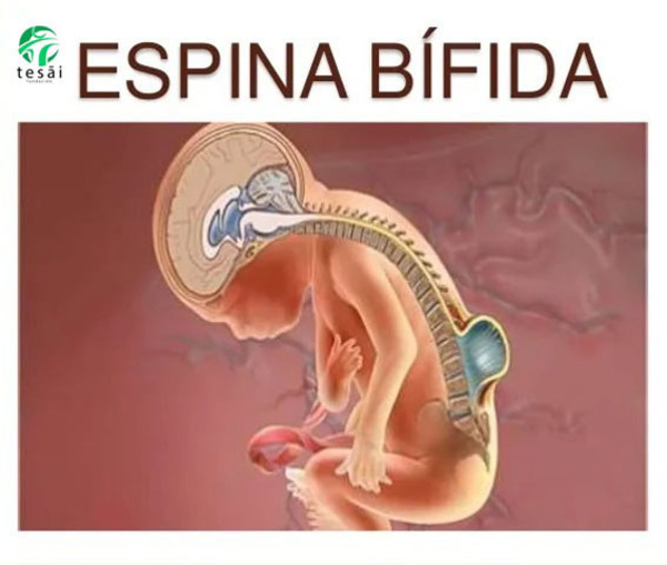 Fundación Tesãi celebra el Día Internacional de la Espina Bífida | DIARIO PRIMERA PLANA