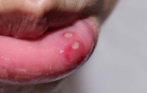 Aumentan consultas por herpes bucal en niños en Coronel Oviedo – Prensa 5