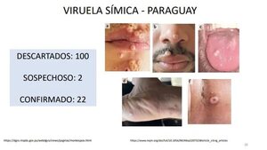 Viruela del mono sigue en aumento y ya hay 22 casos en Paraguay - Nacionales - ABC Color