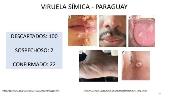 Viruela del mono sigue en aumento y ya hay 22 casos en Paraguay - Nacionales - ABC Color