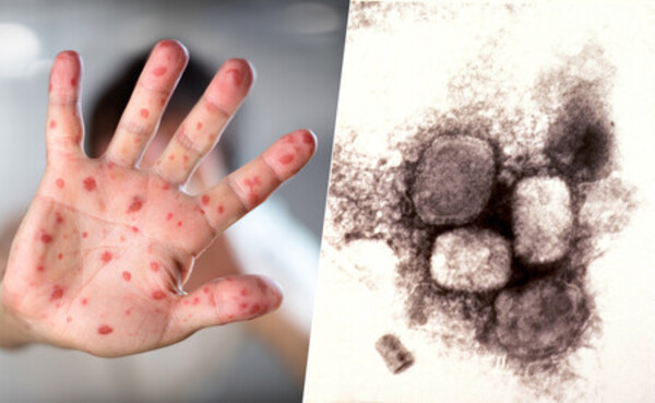 Salud reporta 22 casos de viruela del mono | OnLivePy