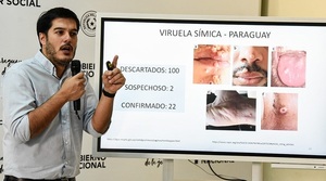 Viruela símica: Paraguay registra 22 casos confirmados | 1000 Noticias