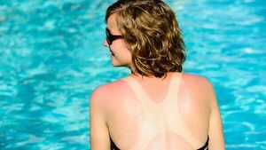 ¿Cuánto dura una quemadura de sol y cómo sanar más rápido?