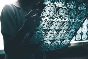 Nuevo fármaco ralentiza deterioro cognitivo de Alzhéimer - Mundo - ABC Color