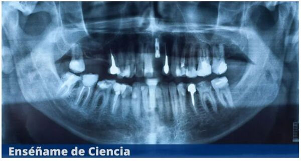 La causa del Alzheimer puede provenir de su boca, de acuerdo con un estudio