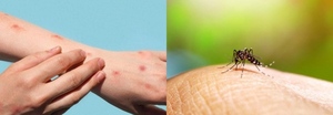 Repunte de casos de viruela símica y dengue en Paraguay