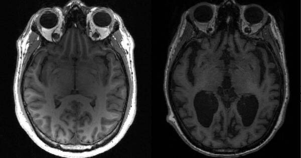 La Nación / Alzheimer: nuevo fármaco ralentiza un 27% el deterioro cognitivo