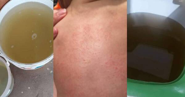 La Nación / Nanawa: ronchas en la piel por culpa del agua sucia, tras “estrenar” nueva planta de tratamiento