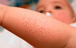 Sepa cómo enfrentar la dermatitis atópica en esta temporada veraniega - .::Agencia IP::.