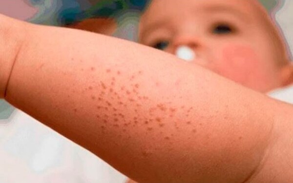 Sepa cómo enfrentar la dermatitis atópica en esta temporada veraniega - .::Agencia IP::.