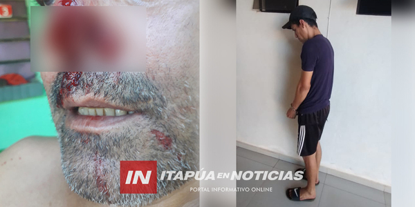 JOVEN ARRANCÓ LA NARIZ A SU PROPIO PADRE DE UN MORDISCO - Itapúa Noticias