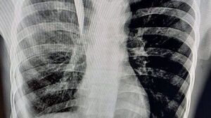 Le perforaron un pulmón a adolescente vendedor
