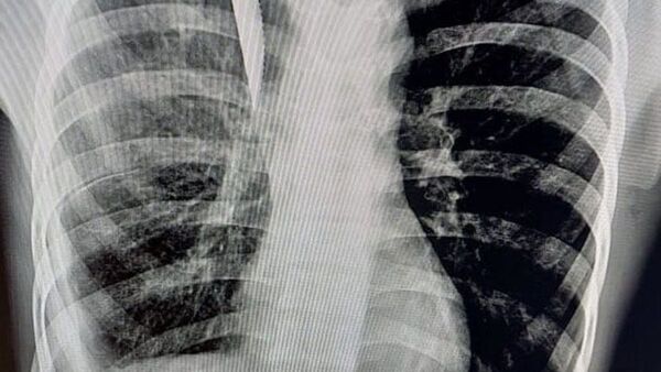 Le perforaron un pulmón a adolescente vendedor